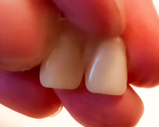 Deux couronnes antérieures de remplacement Denticor reliées, vues de face
