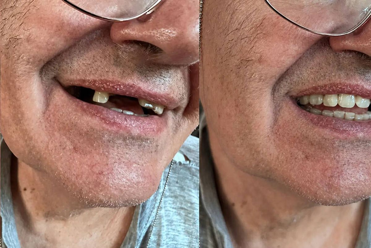 De l’espace vide au sourire avec la prothèse en place