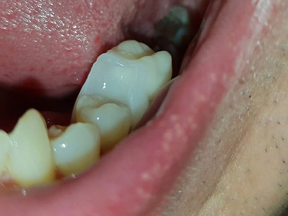 Mise en place de la prothèse Denticor ajustée à l’emplacement de la dent postérieure manquante