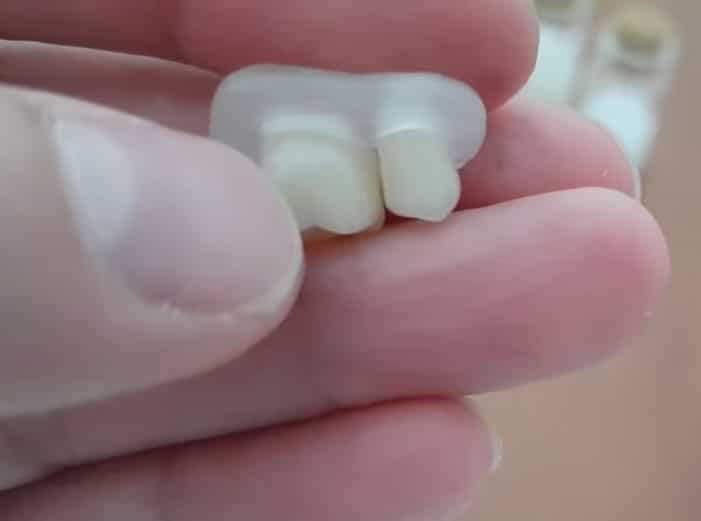 Deux couronnes reliées par un bridge en DentiFlex, vue de l’arrière