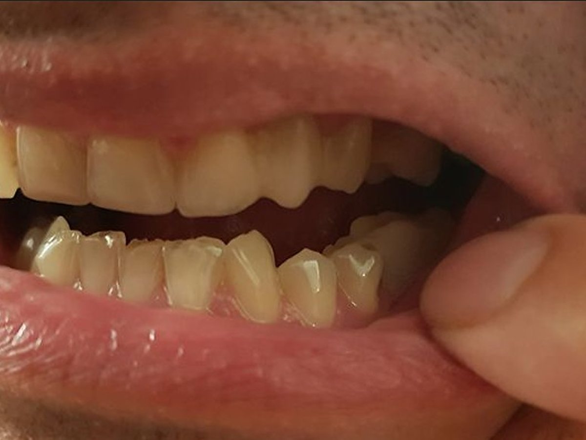 Prothèse Denticor mise en place à l’emplacement de la dent postérieure manquante
