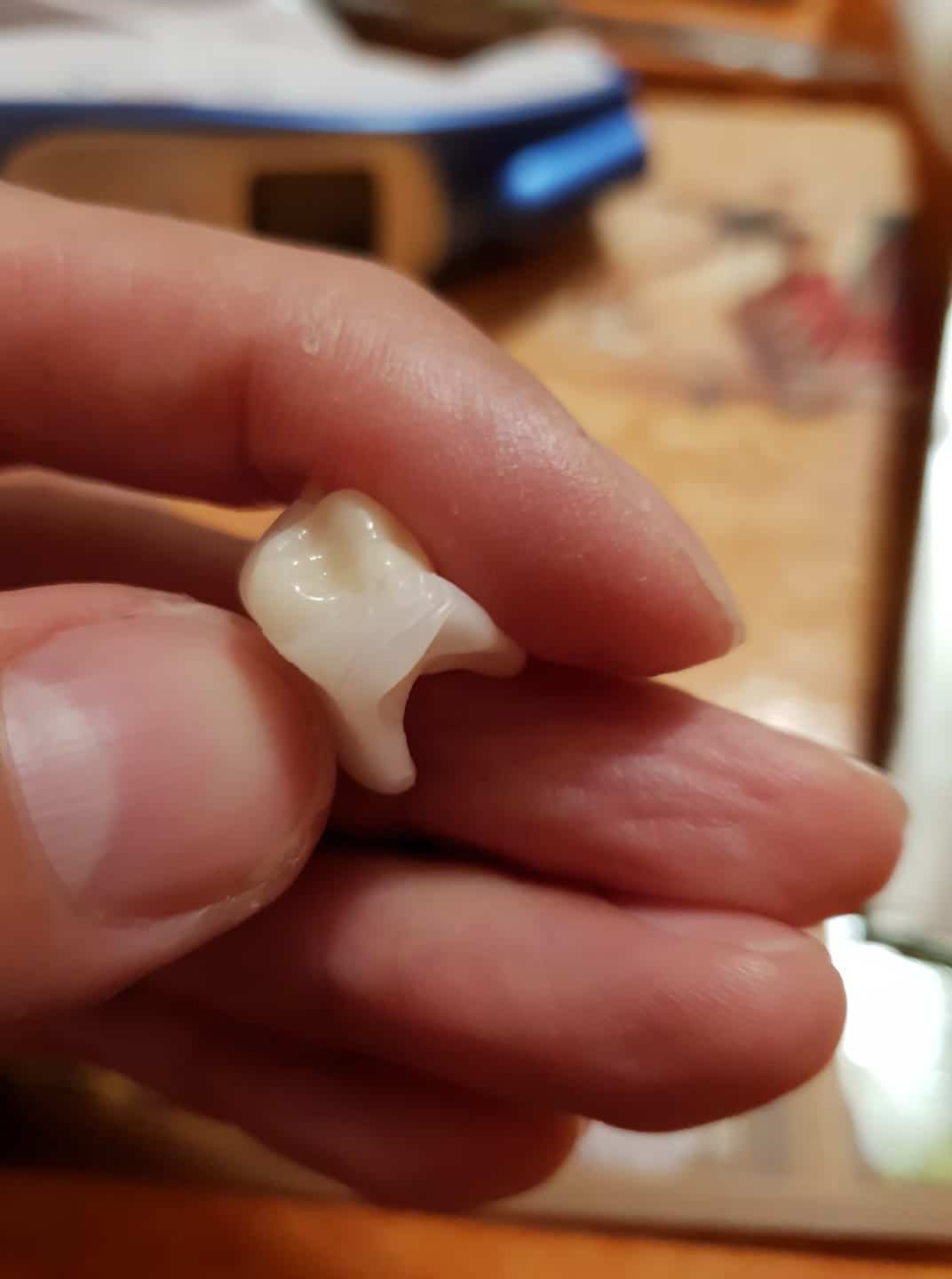 Prothèse dentaire Denticor finale après plusieurs mois de développement