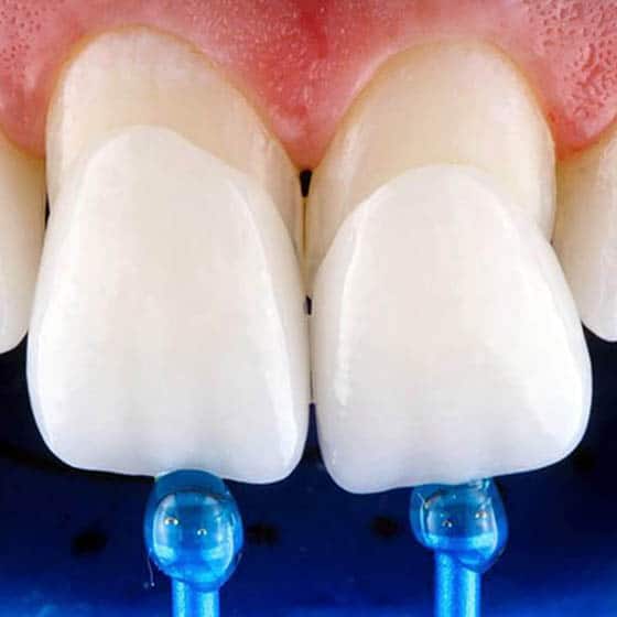 Facettes Denticor – recouvrement esthétique des dents de devant
