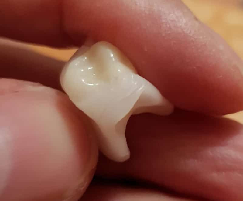 Détail d’une couronne Denticor avec son bridge DentiFlex