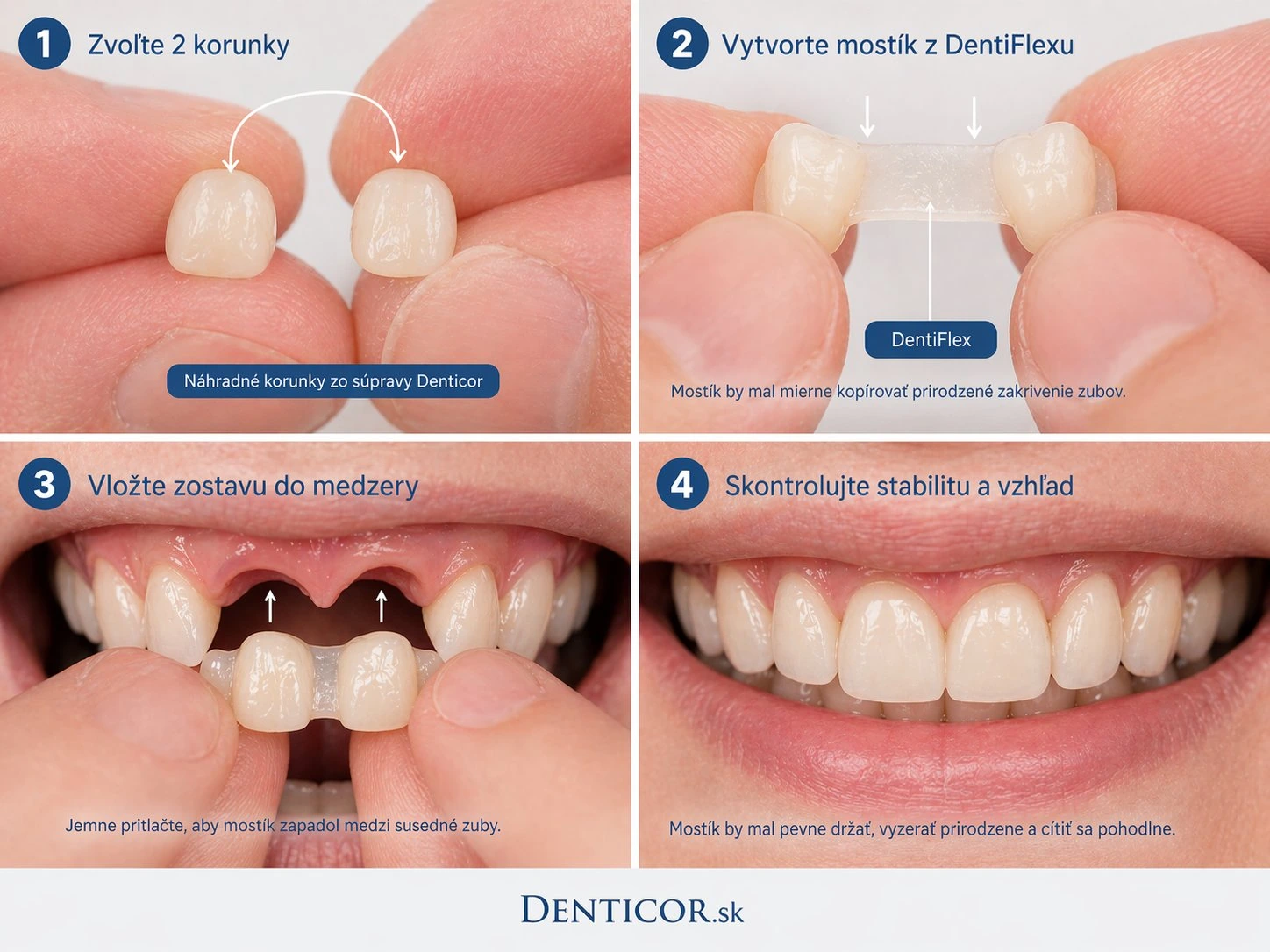 Comment fonctionne Denticor en cas d’absence de deux prémolaires inférieures