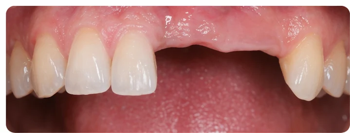 Procédure visuelle pour deux prémolaires et une molaire du bas – principe de mise en place du bridge Denticor avec les nouvelles dents et de son ajustement aux dents adjacentes