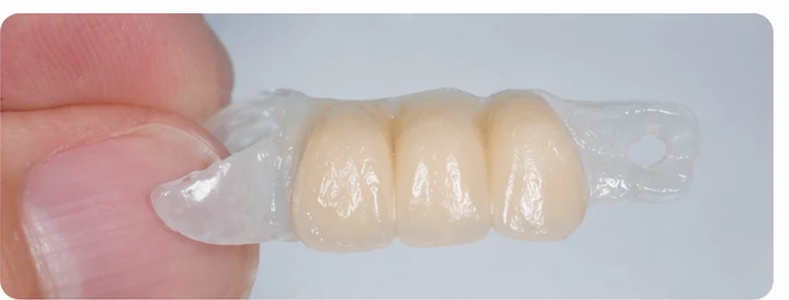 Procédure visuelle pour deux prémolaires et une molaire du bas – principe de mise en place du bridge Denticor avec les nouvelles dents et de son ajustement aux dents adjacentes