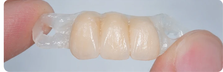 Procédure visuelle pour deux prémolaires et une molaire du bas – principe de mise en place du bridge Denticor avec les nouvelles dents et de son ajustement aux dents adjacentes