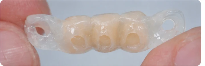 Procédure visuelle pour deux prémolaires et une molaire du bas – principe de mise en place du bridge Denticor avec les nouvelles dents et de son ajustement aux dents adjacentes