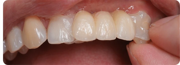 Procédure visuelle pour deux prémolaires et une molaire du bas – principe de mise en place du bridge Denticor avec les nouvelles dents et de son ajustement aux dents adjacentes