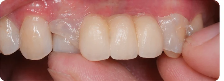 Procédure visuelle pour deux prémolaires et une molaire du bas – principe de mise en place du bridge Denticor avec les nouvelles dents et de son ajustement aux dents adjacentes
