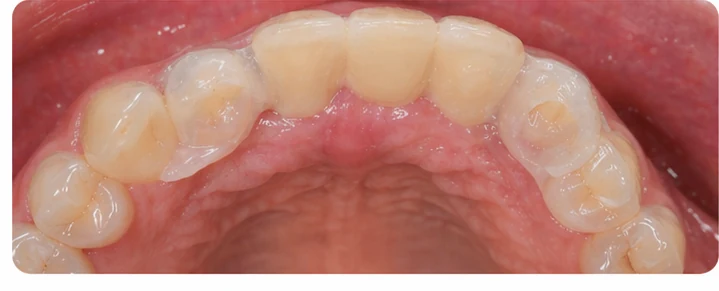 Procédure visuelle pour deux prémolaires et une molaire du bas – principe de mise en place du bridge Denticor avec les nouvelles dents et de son ajustement aux dents adjacentes