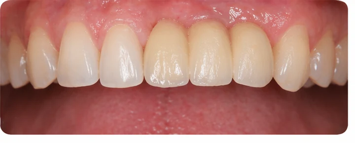 Procédure visuelle pour deux prémolaires et une molaire du bas – principe de mise en place du bridge Denticor avec les nouvelles dents et de son ajustement aux dents adjacentes