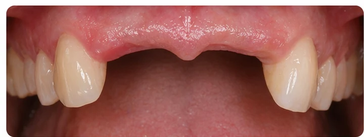 Procédure visuelle pour deux dents antérieures inférieures adjacentes – principe de pose d’un bridge Denticor avec de nouvelles dents et de son ajustement aux dents adjacentes