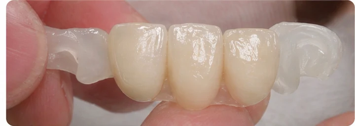 Procédure visuelle pour deux dents antérieures inférieures adjacentes – principe de pose d’un bridge Denticor avec de nouvelles dents et de son ajustement aux dents adjacentes