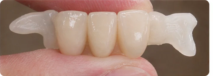 Procédure visuelle pour deux dents antérieures inférieures adjacentes – principe de pose d’un bridge Denticor avec de nouvelles dents et de son ajustement aux dents adjacentes