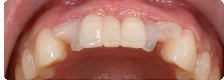 Procédure visuelle pour deux dents antérieures inférieures adjacentes – principe de pose d’un bridge Denticor avec de nouvelles dents et de son ajustement aux dents adjacentes