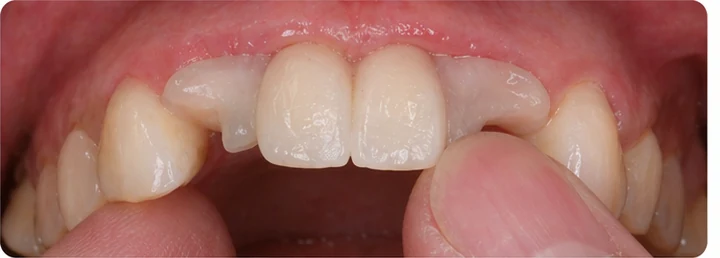 Procédure visuelle pour deux dents antérieures inférieures adjacentes – principe de pose d’un bridge Denticor avec de nouvelles dents et de son ajustement aux dents adjacentes