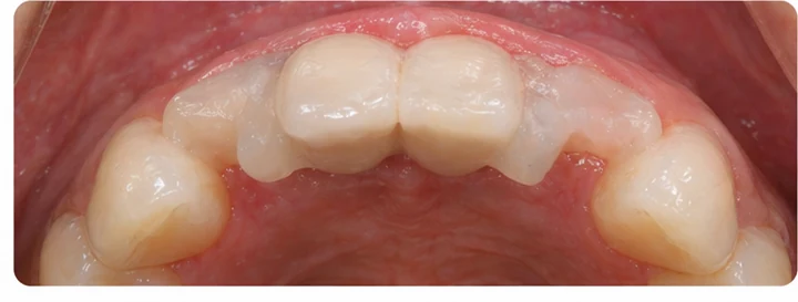 Procédure visuelle pour deux dents antérieures inférieures adjacentes – principe de pose d’un bridge Denticor avec de nouvelles dents et de son ajustement aux dents adjacentes
