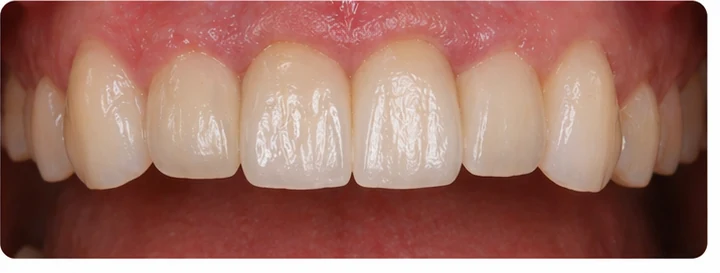 Procédure visuelle pour deux dents antérieures inférieures adjacentes – principe de pose d’un bridge Denticor avec de nouvelles dents et de son ajustement aux dents adjacentes
