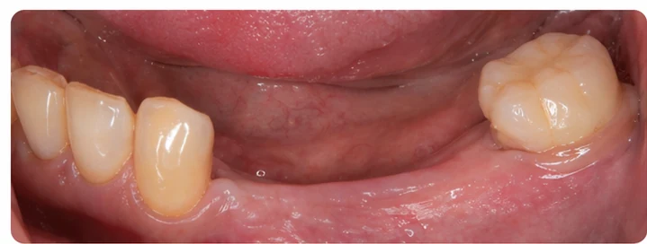 Procédure visuelle pour les trois dents postérieures du bas – principe de pose du bridge Denticor avec les nouvelles dents et de son ajustement aux dents adjacentes
