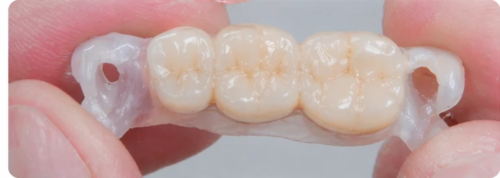 Procédure visuelle pour les trois dents postérieures du bas – principe de pose du bridge Denticor avec les nouvelles dents et de son ajustement aux dents adjacentes