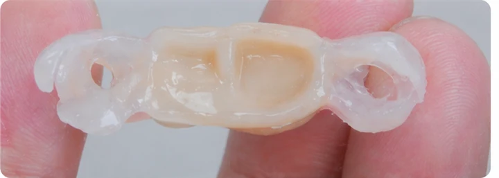 Procédure visuelle pour les trois dents postérieures du bas – principe de pose du bridge Denticor avec les nouvelles dents et de son ajustement aux dents adjacentes