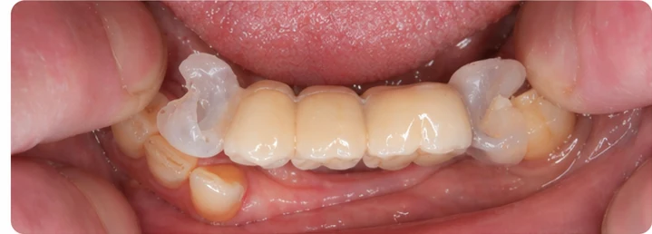 Procédure visuelle pour les trois dents postérieures du bas – principe de pose du bridge Denticor avec les nouvelles dents et de son ajustement aux dents adjacentes
