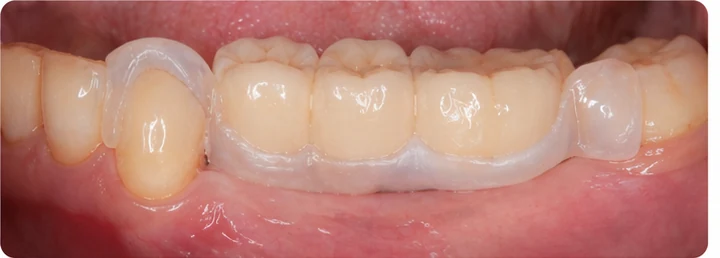 Procédure visuelle pour les trois dents postérieures du bas – principe de pose du bridge Denticor avec les nouvelles dents et de son ajustement aux dents adjacentes