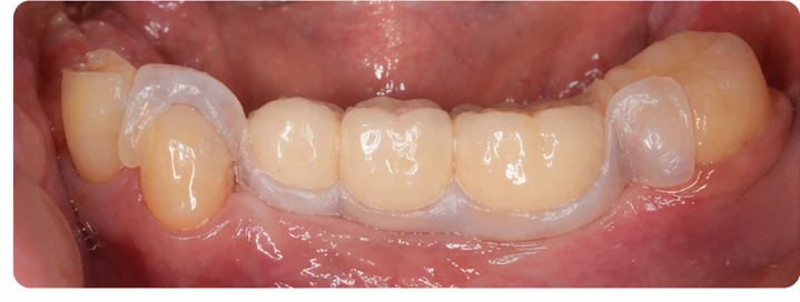 Procédure visuelle pour les trois dents postérieures du bas – principe de pose du bridge Denticor avec les nouvelles dents et de son ajustement aux dents adjacentes