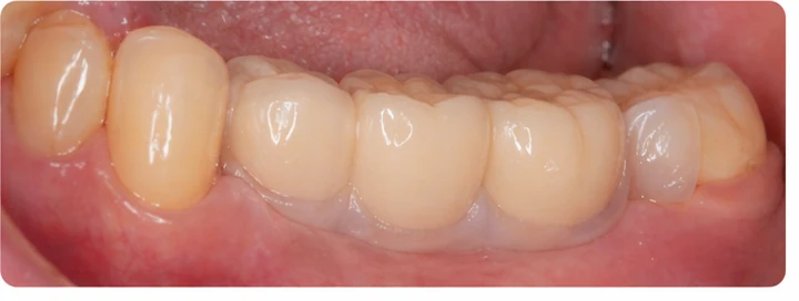 Procédure visuelle pour les trois dents postérieures du bas – principe de pose du bridge Denticor avec les nouvelles dents et de son ajustement aux dents adjacentes