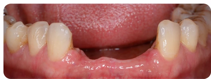Démonstration de la mise en place du Denticor pour une canine inférieure et deux prémolaires : pose de la prothèse et mise en forme de son appui contre les dents voisines