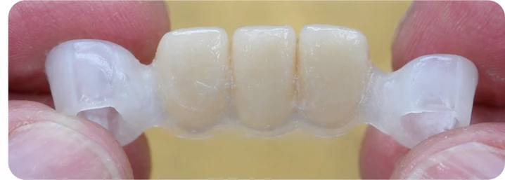 Démonstration de la mise en place du Denticor pour une canine inférieure et deux prémolaires : pose de la prothèse et mise en forme de son appui contre les dents voisines