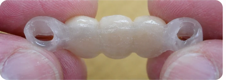 Démonstration de la mise en place du Denticor pour une canine inférieure et deux prémolaires : pose de la prothèse et mise en forme de son appui contre les dents voisines