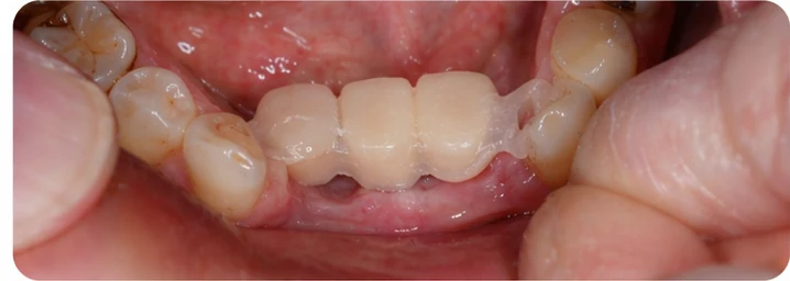 Démonstration de la mise en place du Denticor pour une canine inférieure et deux prémolaires : pose de la prothèse et mise en forme de son appui contre les dents voisines