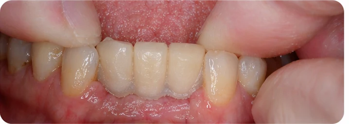 Démonstration de la mise en place du Denticor pour une canine inférieure et deux prémolaires : pose de la prothèse et mise en forme de son appui contre les dents voisines