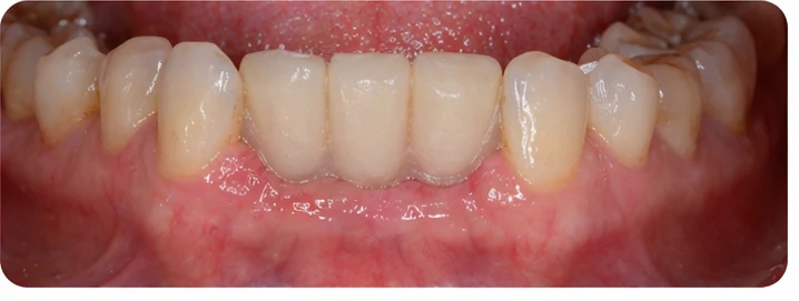 Démonstration de la mise en place du Denticor pour une canine inférieure et deux prémolaires : pose de la prothèse et mise en forme de son appui contre les dents voisines