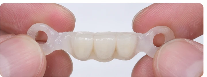 Procédure visuelle pour trois dents adjacentes de l’arcade inférieure – principe de pose d’un bridge Denticor avec de nouvelles dents et de son ajustement aux dents environnantes