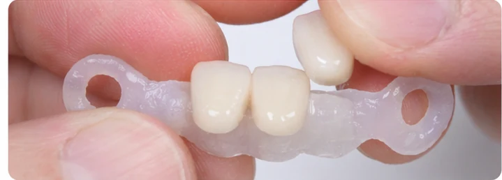 Guide visuel – trois dents antérieures supérieures manquantes