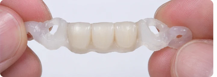 Guide visuel – trois dents antérieures supérieures manquantes