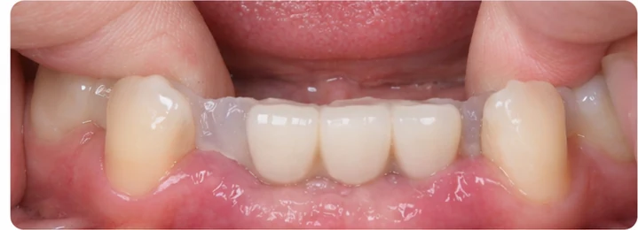 Guide visuel – trois dents antérieures supérieures manquantes