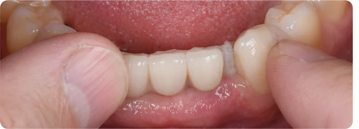 Guide visuel – trois dents antérieures supérieures manquantes