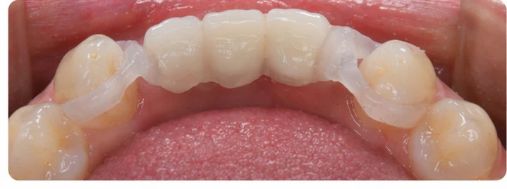 Guide visuel – trois dents antérieures supérieures manquantes