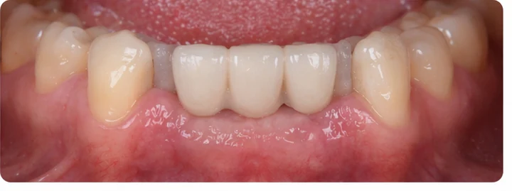 Procédure visuelle pour trois dents adjacentes de l’arcade inférieure – principe de pose d’un bridge Denticor avec de nouvelles dents et de son ajustement aux dents environnantes