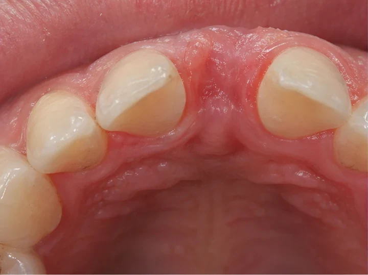 Vue de dos des dents antérieures : DentiFlex forme un verrou derrière les dents adjacentes