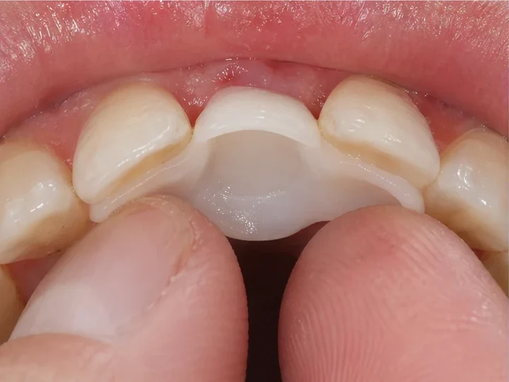 Vue de dos des dents antérieures : DentiFlex forme un verrou derrière les dents adjacentes