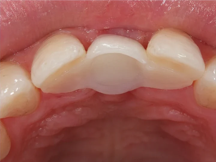 2 · La pièce complète soutenue par les dents adjacentes