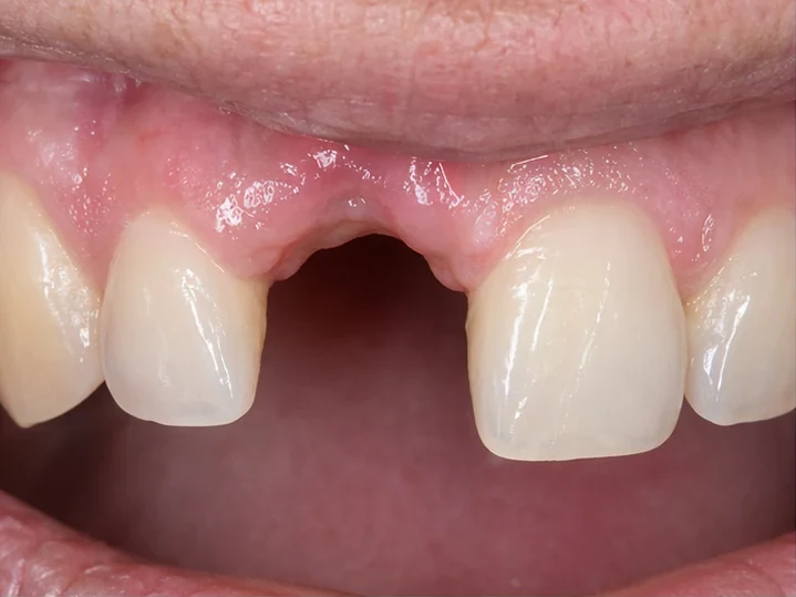 Vue de face : dent antérieure manquante, couronne en DentiFlex, insertion entre les dents adjacentes et résultat