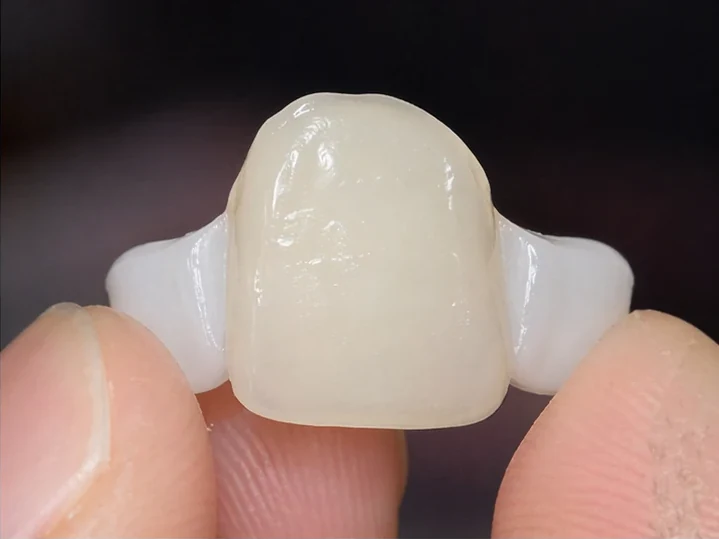 Vue de face : dent antérieure manquante, couronne en DentiFlex, insertion entre les dents adjacentes et résultat