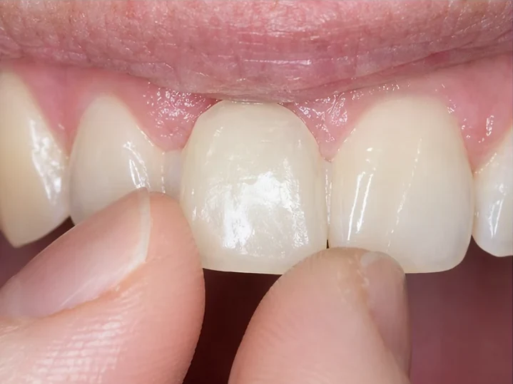 Vue de face : dent antérieure manquante, couronne en DentiFlex, insertion entre les dents adjacentes et résultat